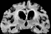 Laminar Necrosis, internal carotid circulations, bilateral